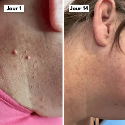 Vantyx Skin Tag Remover Kit